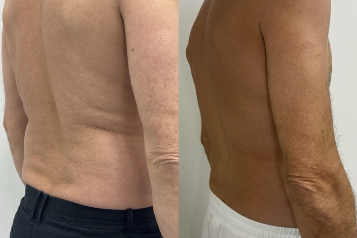 EMSculpt NEO Before and After Photos in Miami Beach, FL, Patient 10811