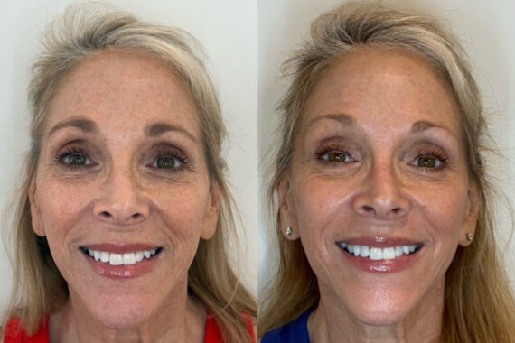 Chemical Peels Before and After Photos in Miami Beach, FL, Patient 10847