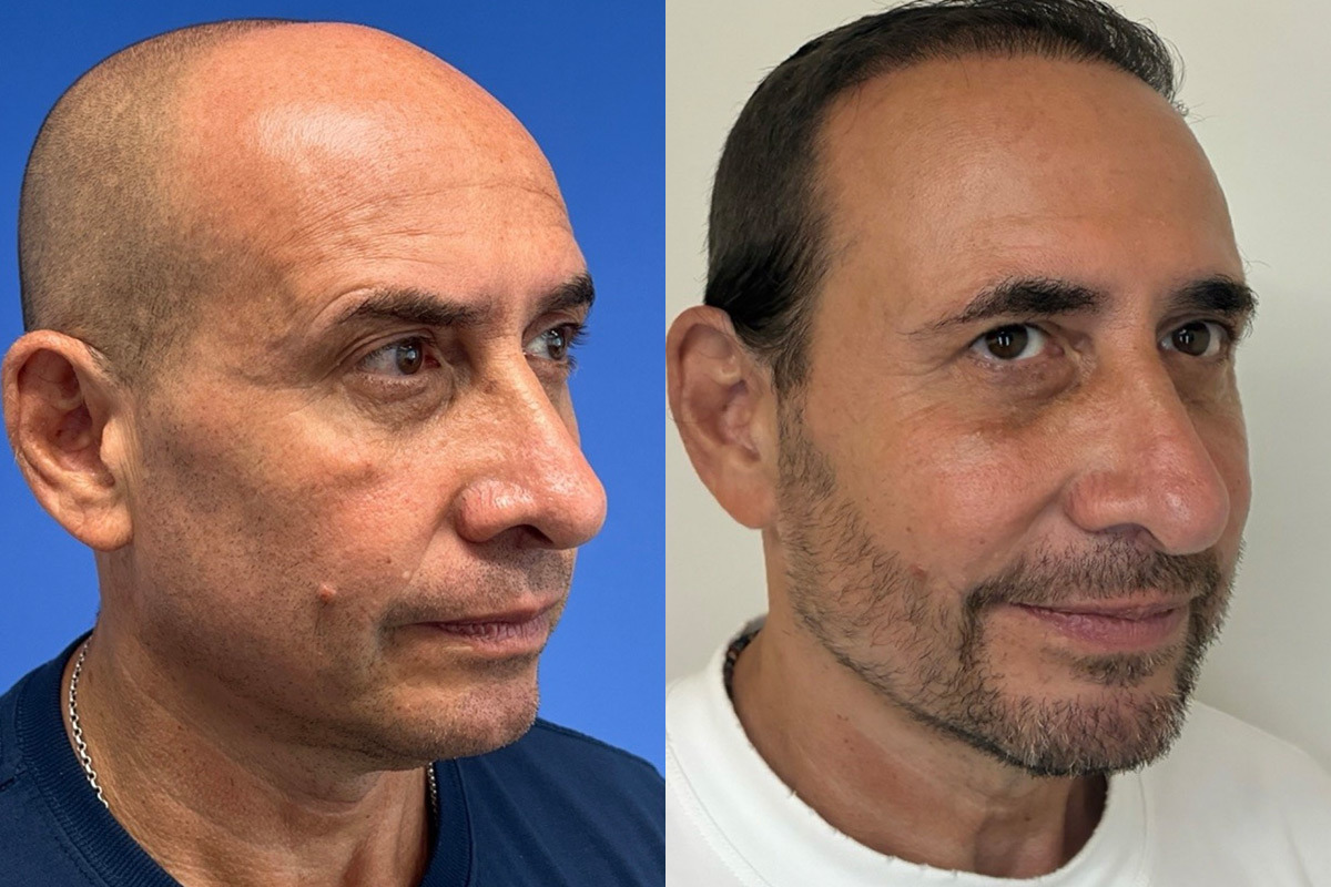 Morpheus8 Before and After Photos in Miami Beach, FL, Patient 11010