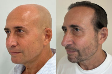Morpheus8 Before and After Photos in Miami Beach, FL, Patient 11010