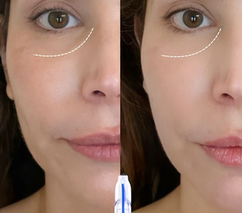 micronjet treatment at BODYWELLE