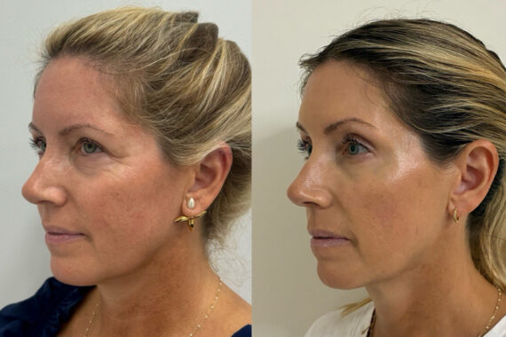 Botox Before and After Photos in Miami Beach, FL, Patient 11616