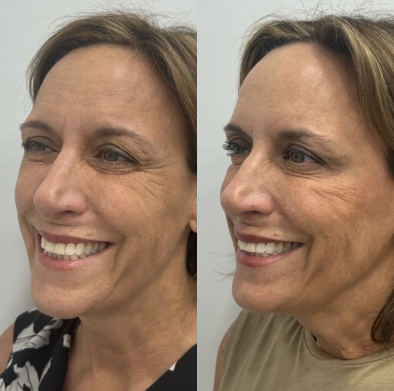 patient-11621-botox-before-after