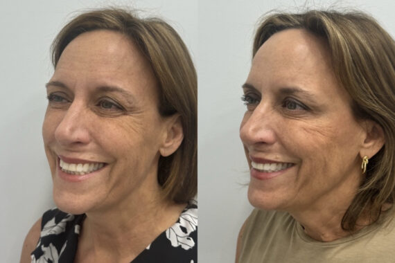 Botox Before and After Photos in Miami Beach, FL, Patient 11621