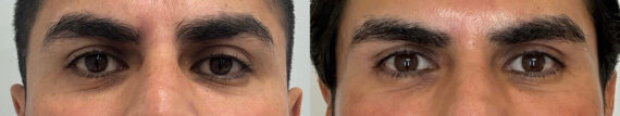 Micronjet/Mesoinjections Before and After Photos in Miami Beach, FL, Patient 11661