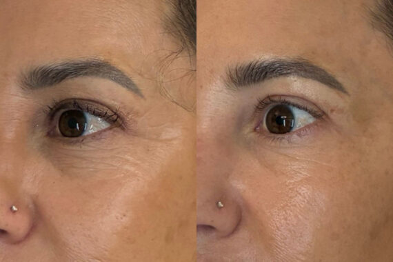 Micronjet/Mesoinjections Before and After Photos in Miami Beach, FL, Patient 11669