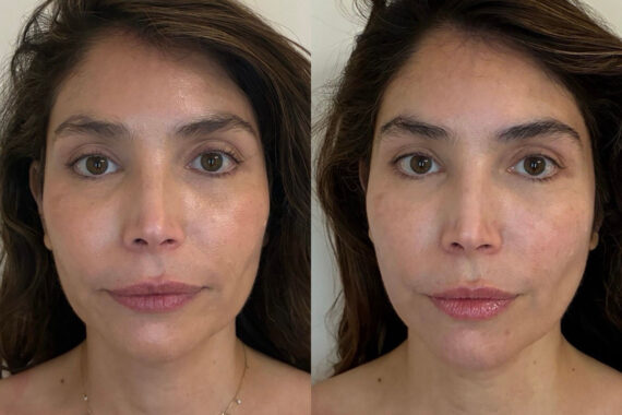 Micronjet/Mesoinjections Before and After Photos in Miami Beach, FL, Patient 11671