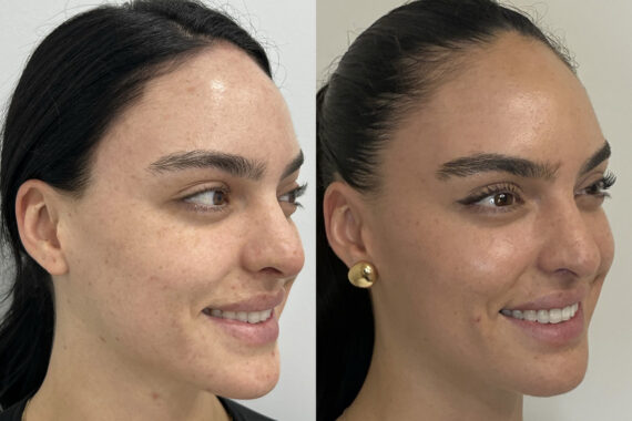 Microneedling Before and After Photos in Miami Beach, FL, Patient 11693