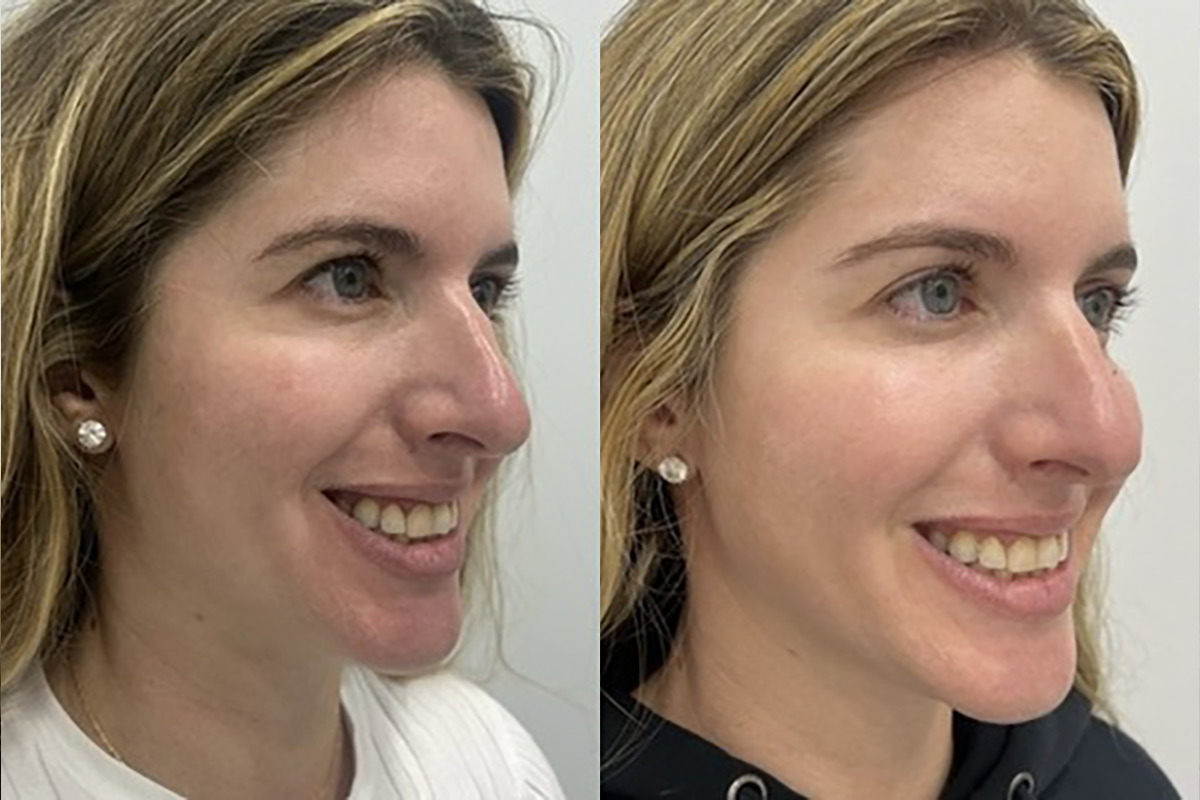Clear & Brilliant Before and After Photos in Miami Beach, FL, Patient 11703