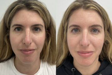 Clear & Brilliant Before and After Photos in Miami Beach, FL, Patient 11703
