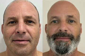 Clear & Brilliant Before and After Photos in Miami Beach, FL, Patient 11718
