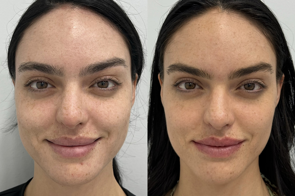 Clear & Brilliant Before and After Photos in Miami Beach, FL, Patient 11720