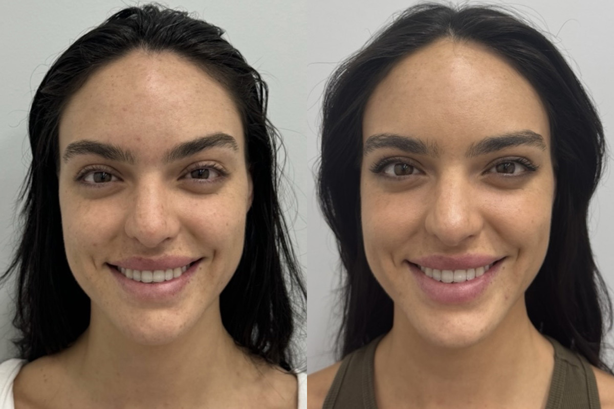 Clear & Brilliant Before and After Photos in Miami Beach, FL, Patient 11720