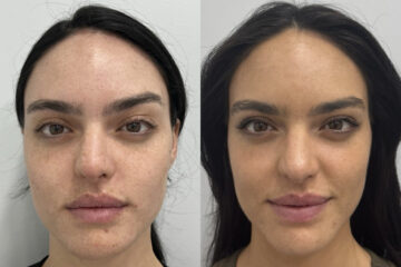 Clear & Brilliant Before and After Photos in Miami Beach, FL, Patient 11720
