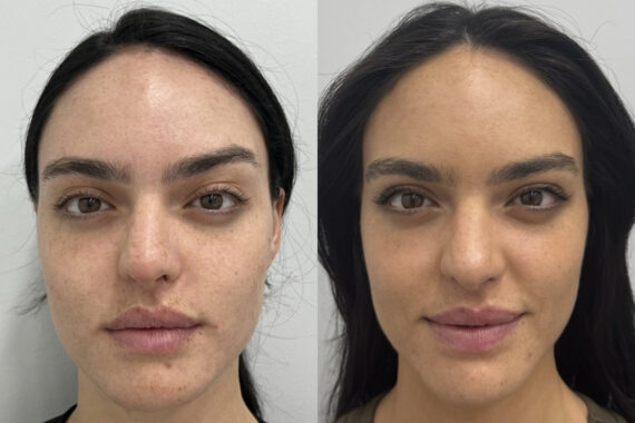 Clear & Brilliant Before and After Photos in Miami Beach, FL, Patient 11720