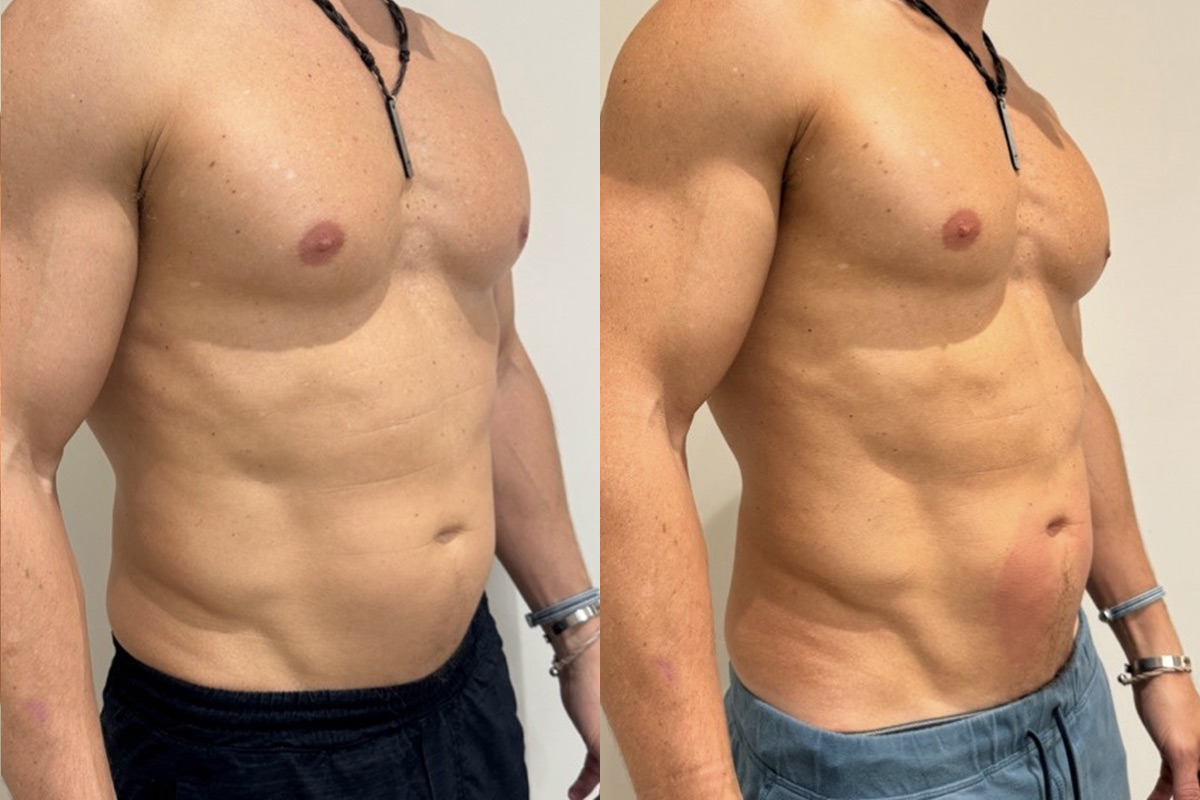 EMSculpt NEO Before and After Photos in Miami Beach, FL, Patient 11760