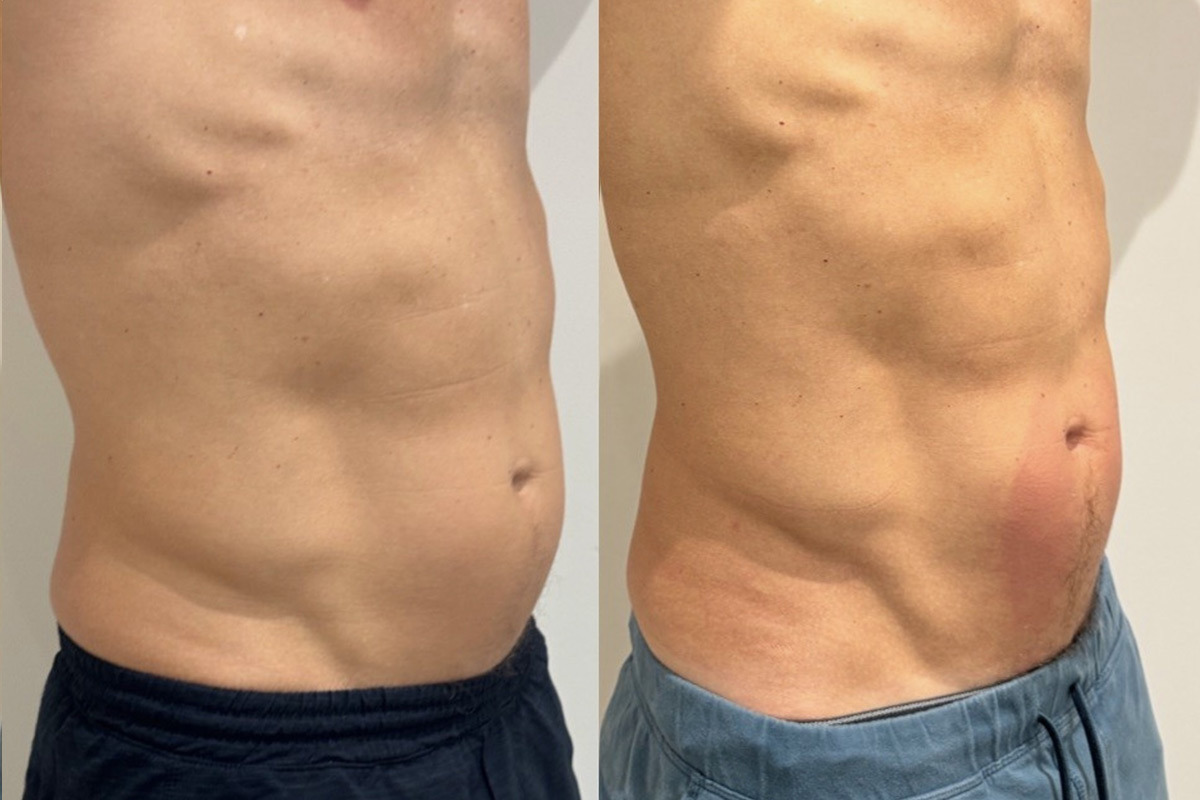 EMSculpt NEO Before and After Photos in Miami Beach, FL, Patient 11760