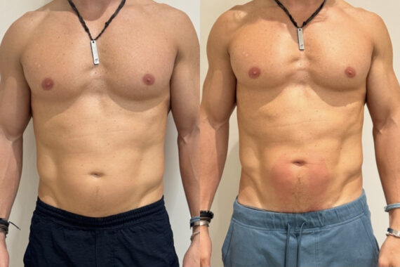 EMSculpt NEO Before and After Photos in Miami Beach, FL, Patient 11760