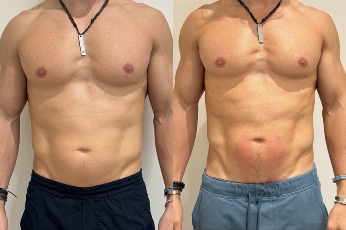 EMSculpt NEO Before and After Photos in Miami Beach, FL, Patient 11760