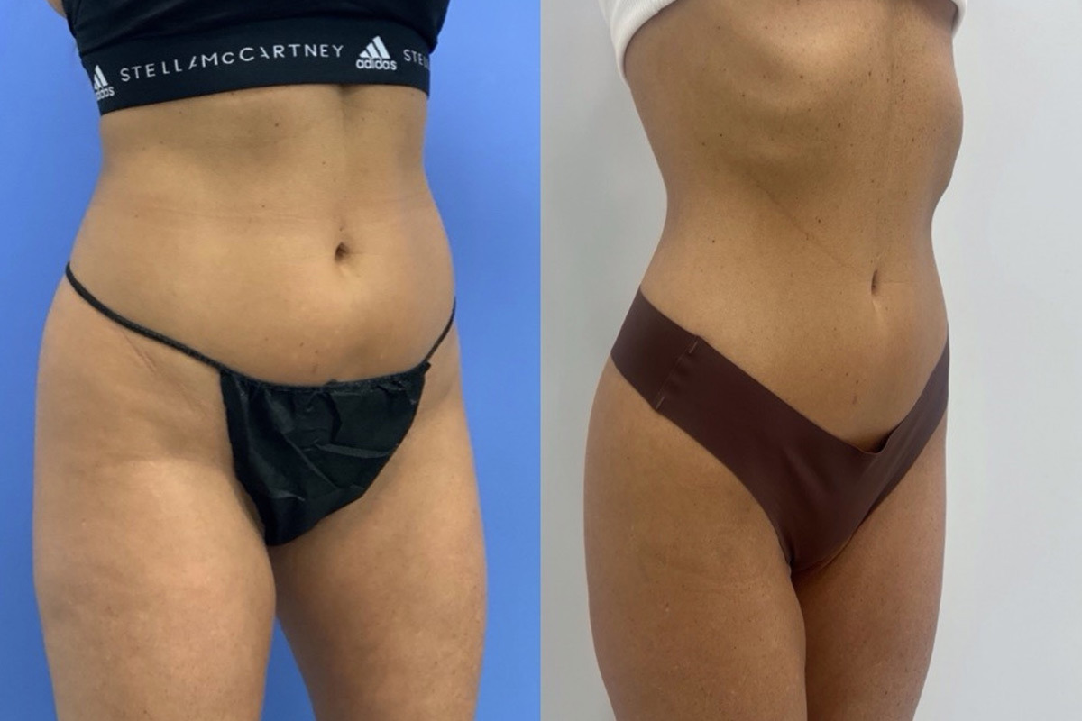 EMSculpt NEO Before and After Photos in Miami Beach, FL, Patient 11764