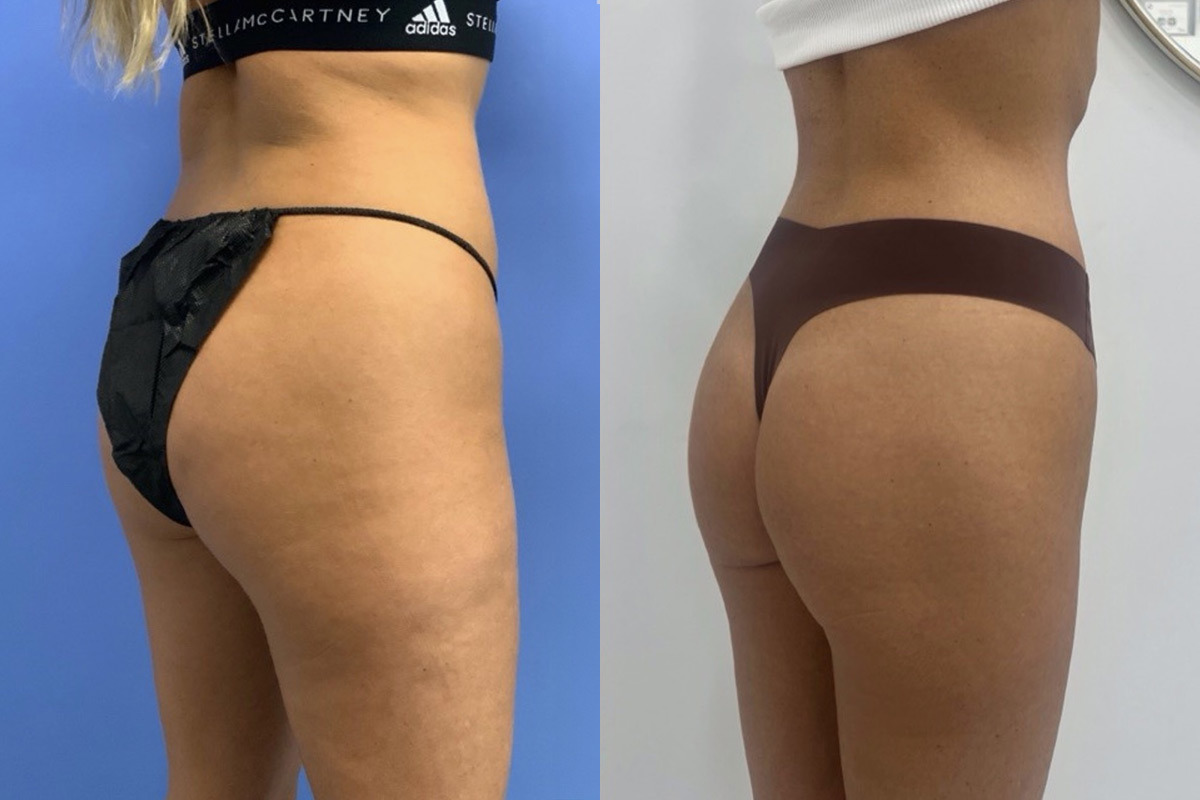 EMSculpt NEO Before and After Photos in Miami Beach, FL, Patient 11764