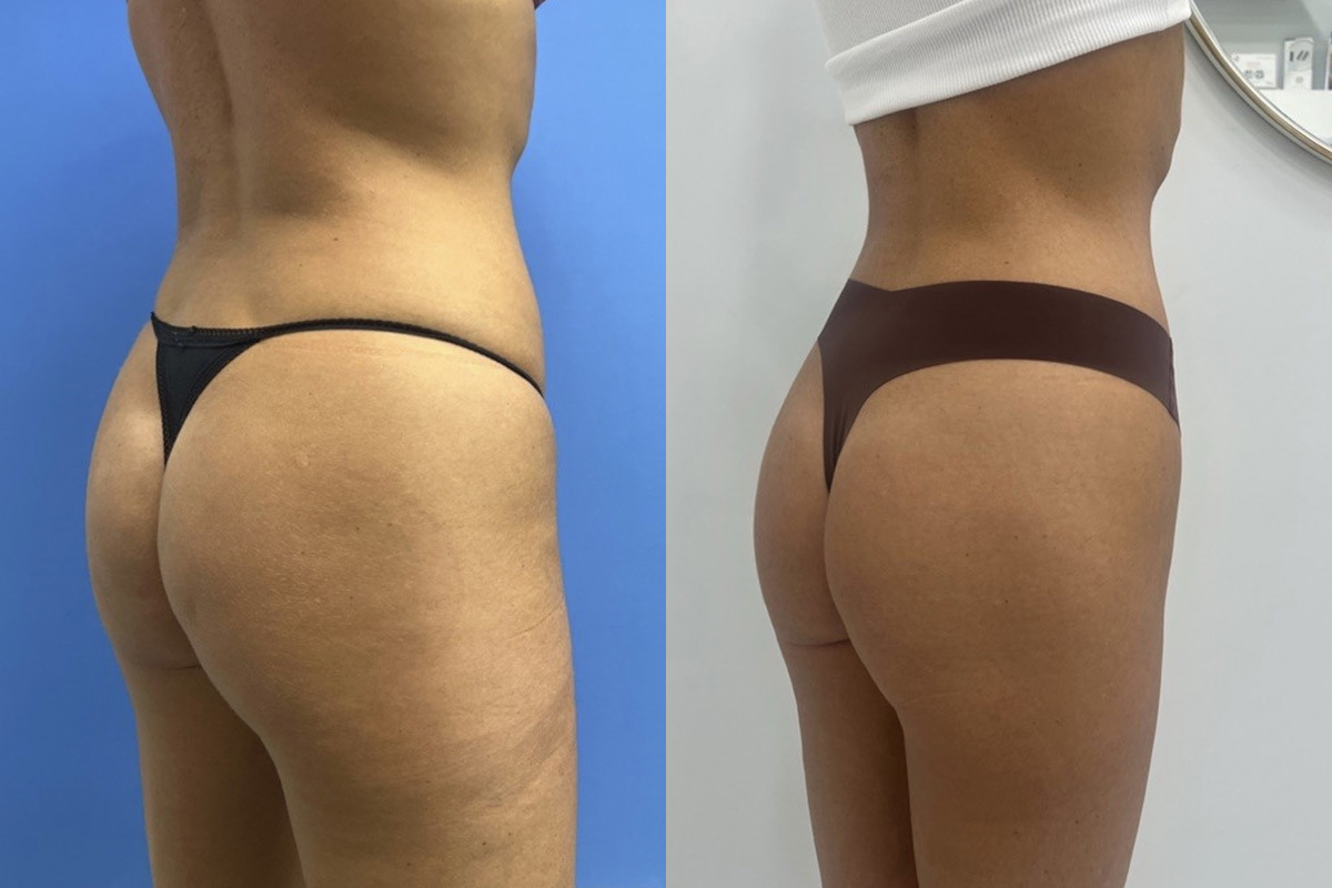 EMSculpt NEO Before and After Photos in Miami Beach, FL, Patient 11764
