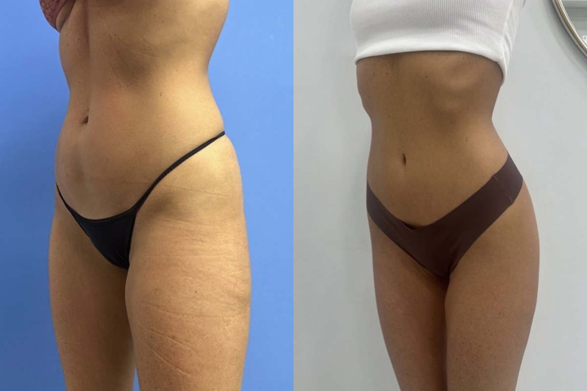 EMSculpt NEO Before and After Photos in Miami Beach, FL, Patient 11764