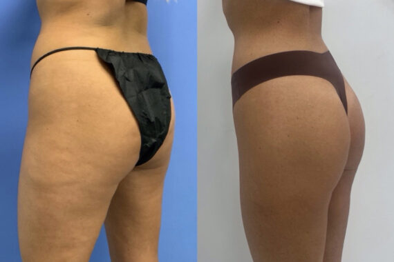 EMSculpt NEO Before and After Photos in Miami Beach, FL, Patient 11764