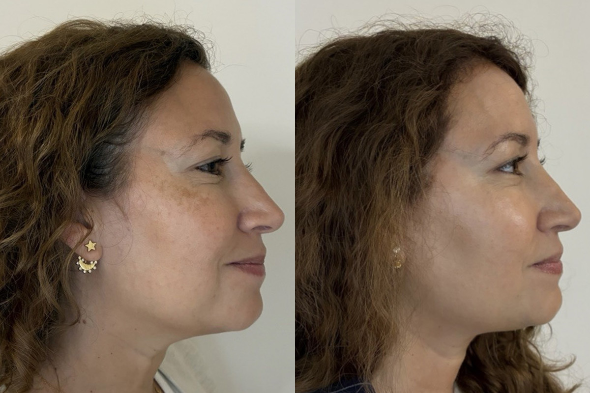 IPL Treatment Before and After Photos in Miami Beach, FL, Patient 11771