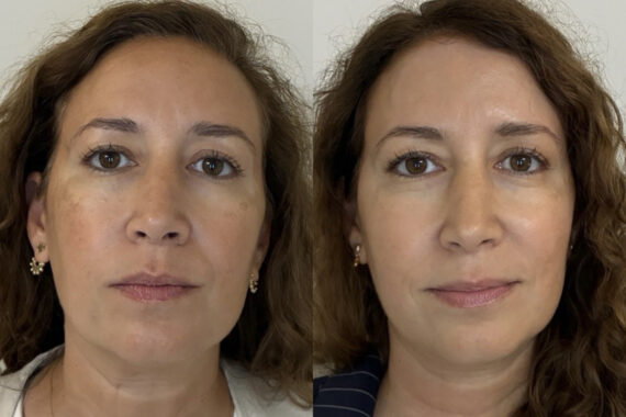 IPL Treatment Before and After Photos in Miami Beach, FL, Patient 11771