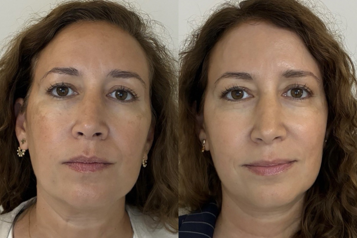 IPL Treatment Before and After Photos in Miami Beach, FL, Patient 11771