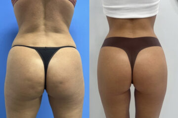 Morpheus8 Before and After Photos in Miami Beach, FL, Patient 11778