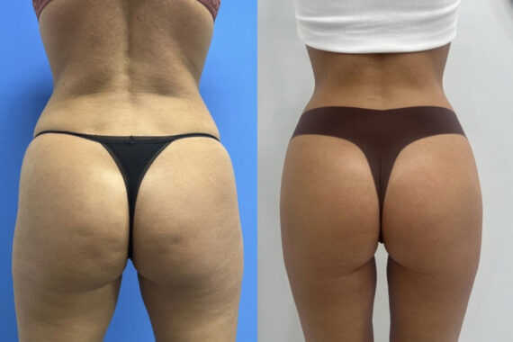 Morpheus8 Before and After Photos in Miami Beach, FL, Patient 11778