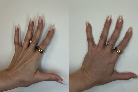 Radiesse Before and After Photos in Miami Beach, FL, Patient 11780