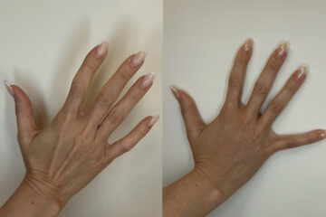 Radiesse Before and After Photos in Miami Beach, FL, Patient 11790
