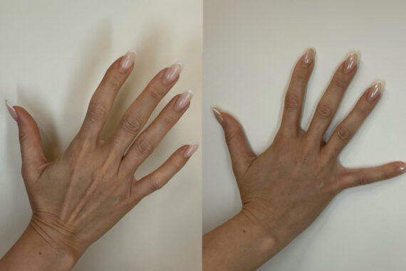 Radiesse Before and After Photos in Miami Beach, FL, Patient 11790
