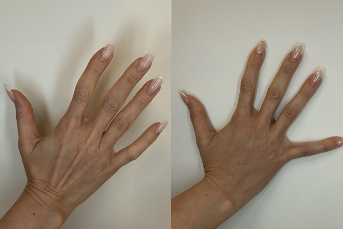 Radiesse Before and After Photos in Miami Beach, FL, Patient 11790