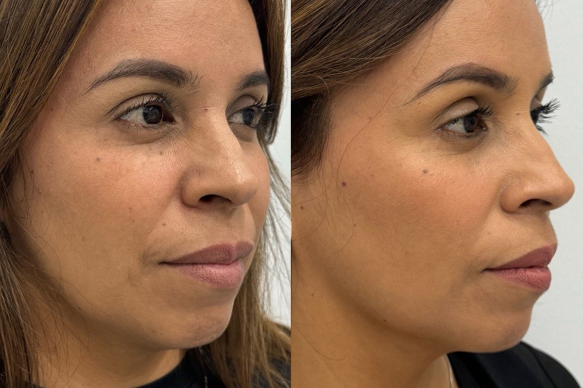Radiesse Before and After Photos in Miami Beach, FL, Patient 11792