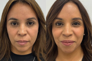 Radiesse Before and After Photos in Miami Beach, FL, Patient 11792