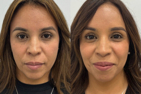 Radiesse Before and After Photos in Miami Beach, FL, Patient 11792