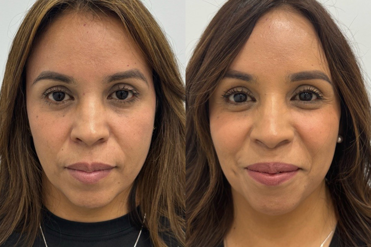 Radiesse Before and After Photos in Miami Beach, FL, Patient 11792