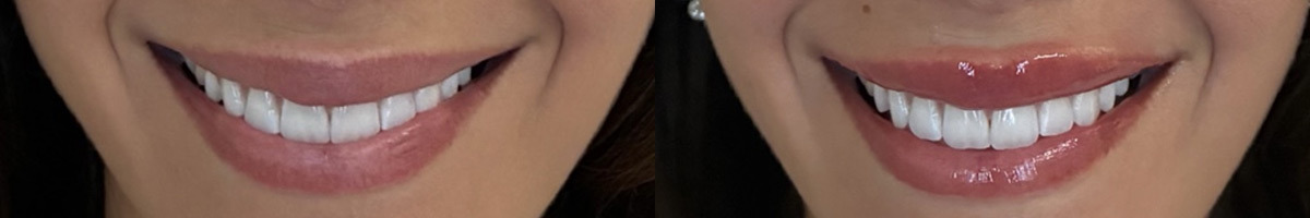 Lip Fillers Before and After Photos in Miami Beach, FL, Patient 11797