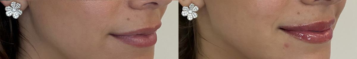Lip Fillers Before and After Photos in Miami Beach, FL, Patient 11797