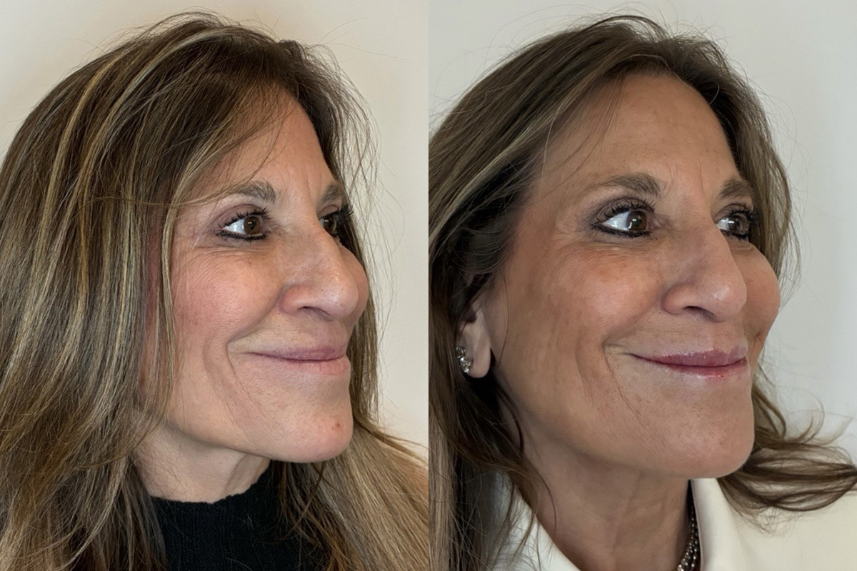 Lip Fillers Before and After Photos in Miami Beach, FL, Patient 11834