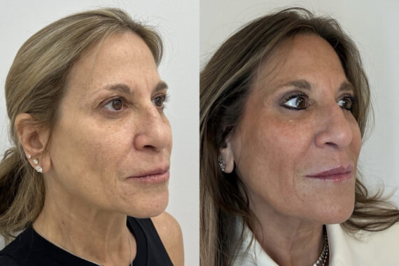 Lip Fillers Before and After Photos in Miami Beach, FL, Patient 11834