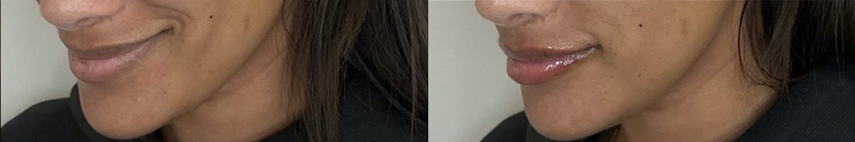 Lip Fillers Before and After Photos in Miami Beach, FL, Patient 11842