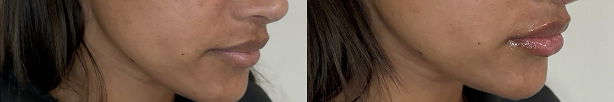 Lip Fillers Before and After Photos in Miami Beach, FL, Patient 11842