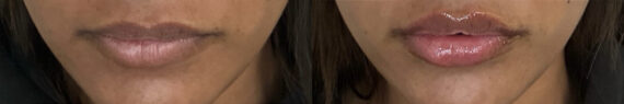 Lip Fillers Before and After Photos in Miami Beach, FL, Patient 11842