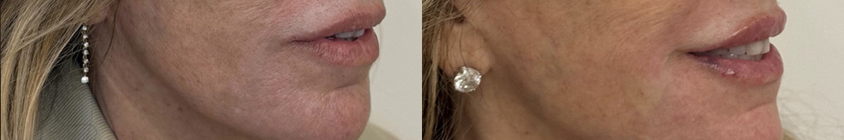 Lip Fillers Before and After Photos in Miami Beach, FL, Patient 11846