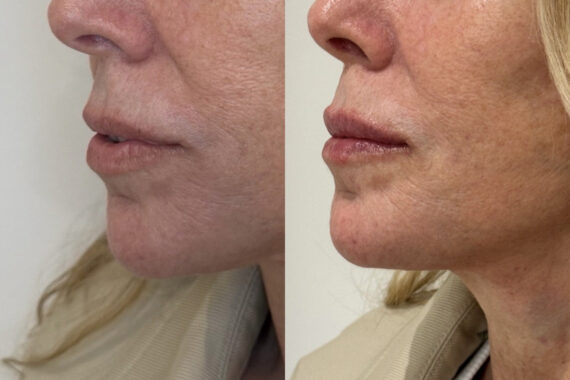 Lip Fillers Before and After Photos in Miami Beach, FL, Patient 11846